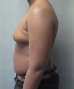 Severe Gynecomastia