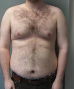 Severe Gynecomastia