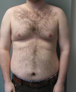 Severe Gynecomastia Before Photo Severe Gynecomastia