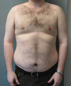 Severe Gynecomastia