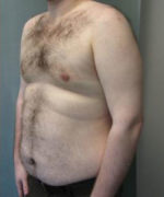 Severe Gynecomastia