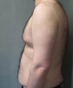 Severe Gynecomastia