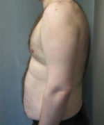 Severe Gynecomastia