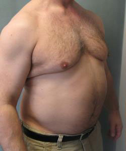 Severe Gynecomastia