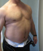 Severe Gynecomastia