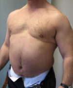 Severe Gynecomastia