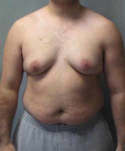 Severe Gynecomastia Before Photo Severe Gynecomastia