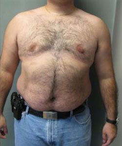 Severe Gynecomastia