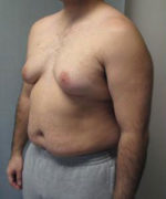 Severe Gynecomastia