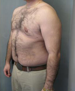 Severe Gynecomastia