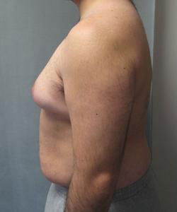 Severe Gynecomastia