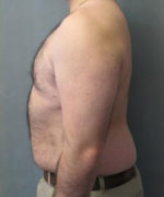 Severe Gynecomastia