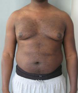 Severe Gynecomastia Before Photo Severe Gynecomastia