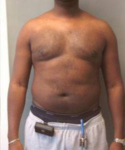 Severe Gynecomastia After Photo Severe Gynecomastia
