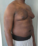 Severe Gynecomastia