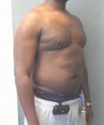 Severe Gynecomastia