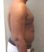 Severe Gynecomastia