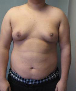 Severe Gynecomastia Before Photo Severe Gynecomastia