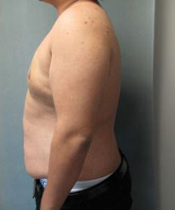 Severe Gynecomastia