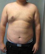 Severe Gynecomastia