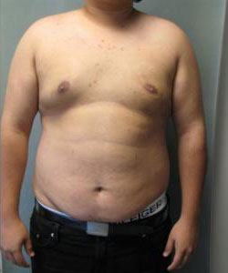 Severe Gynecomastia After Photo Severe Gynecomastia