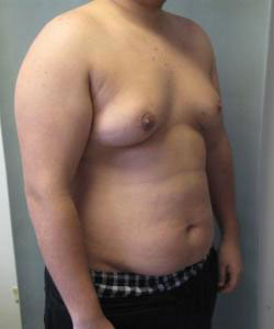 Severe Gynecomastia