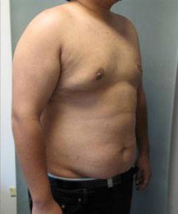 Severe Gynecomastia