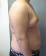 Severe Gynecomastia