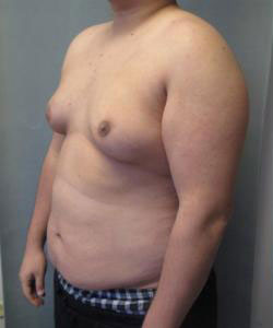 Severe Gynecomastia