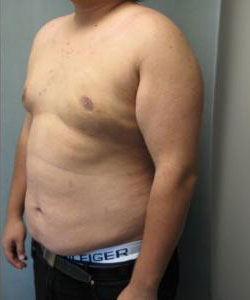 Severe Gynecomastia