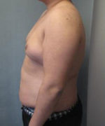 Severe Gynecomastia