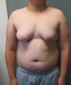 Severe Gynecomastia Before Photo Severe Gynecomastia