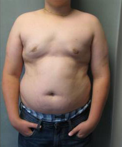 Severe Gynecomastia After Photo Severe Gynecomastia
