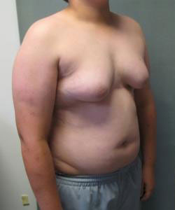 Severe Gynecomastia