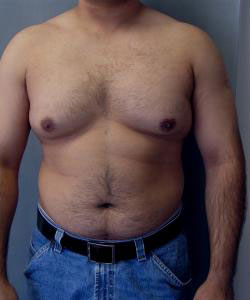 Severe Gynecomastia Before Photo Severe Gynecomastia