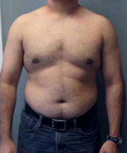 Severe Gynecomastia