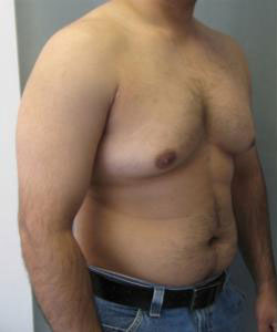 Severe Gynecomastia