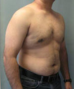 Severe Gynecomastia