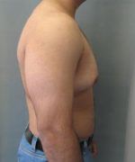 Severe Gynecomastia