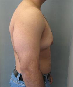 Severe Gynecomastia