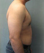 Severe Gynecomastia