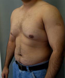 Severe Gynecomastia