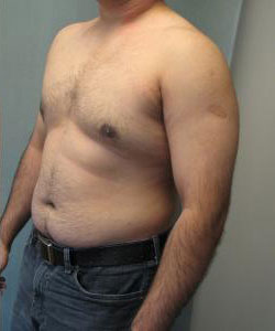 Severe Gynecomastia