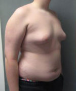 Severe Gynecomastia