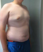 Severe Gynecomastia