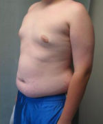 Severe Gynecomastia