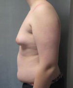 Severe Gynecomastia