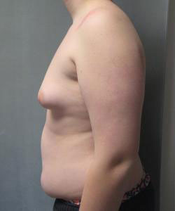 Severe Gynecomastia