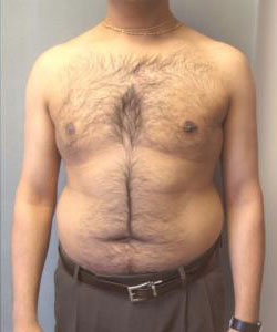 Severe Gynecomastia