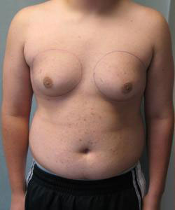 Severe Gynecomastia